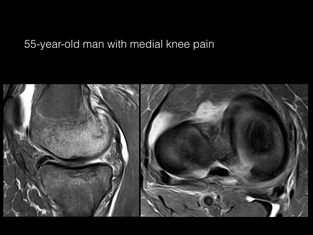 Figure 1 for case stress fracture ( RID4695 ) Osteonecrosis Meniscal Root tear